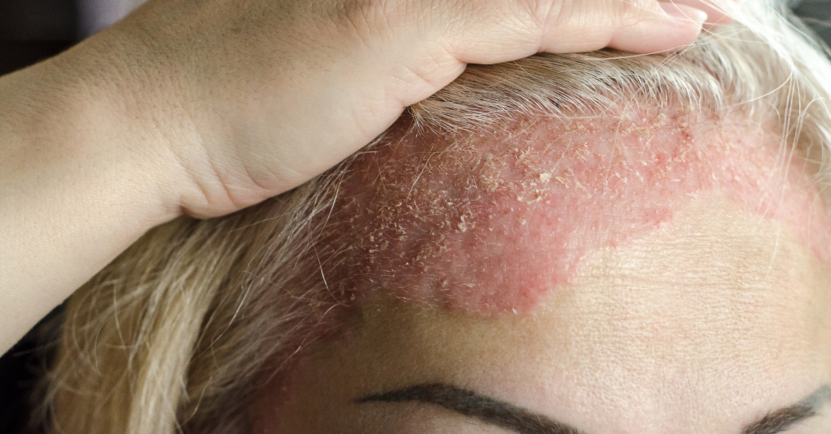Psoriasis & Eksem – Såhär säger våra kunder